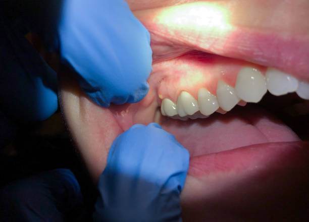 Best Dental Abscess Treatment in Richlands, NC